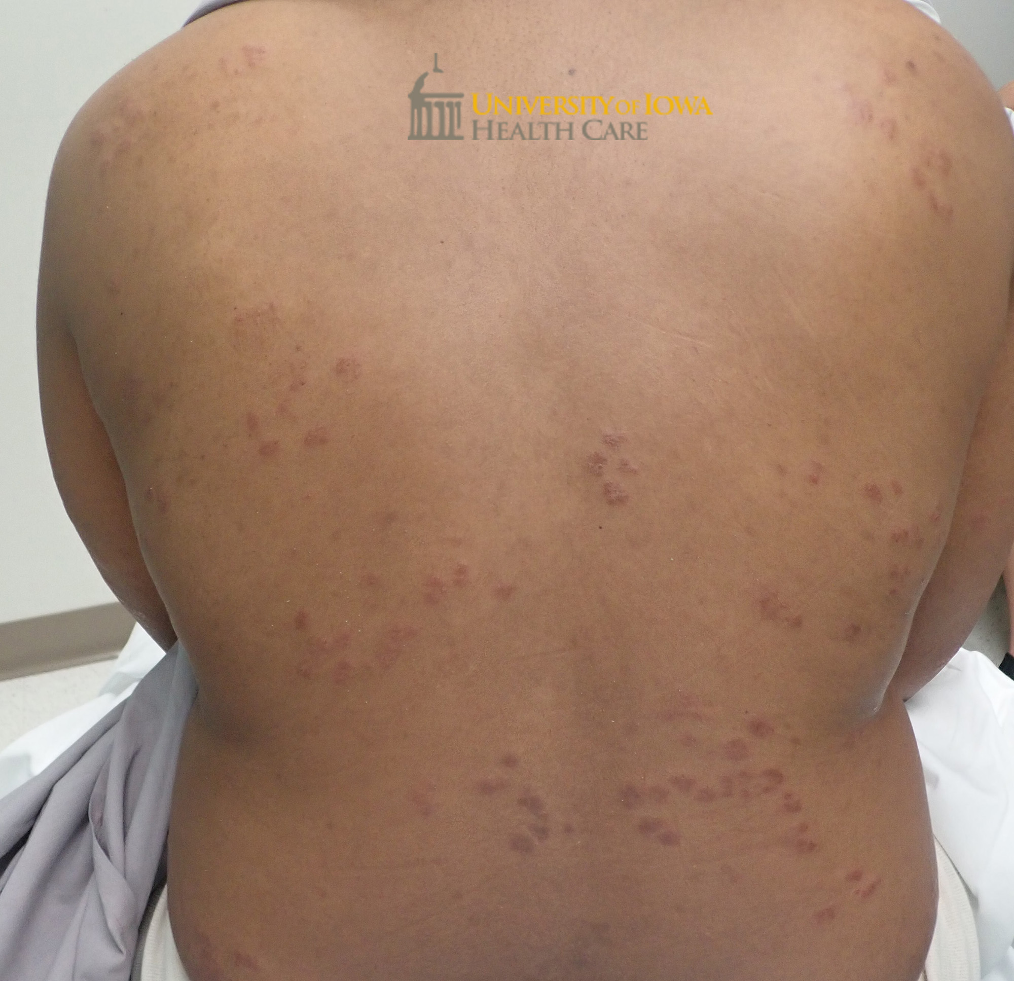 Annular red-brown plaques and papules on the back. (click images for higher resolution).